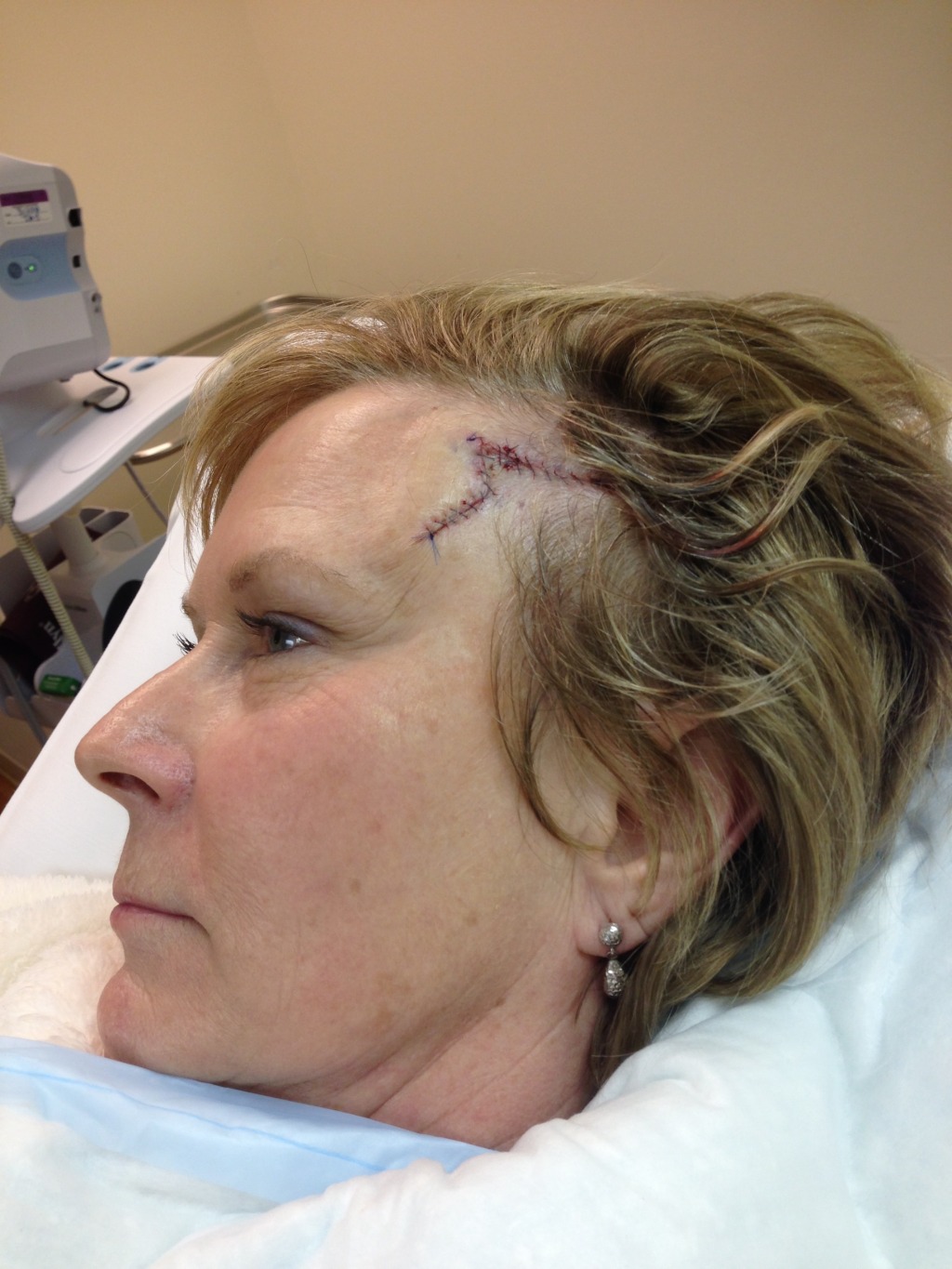 2014-03-05 11-45-14 Basal Cell Carcinoma surgery.jpg